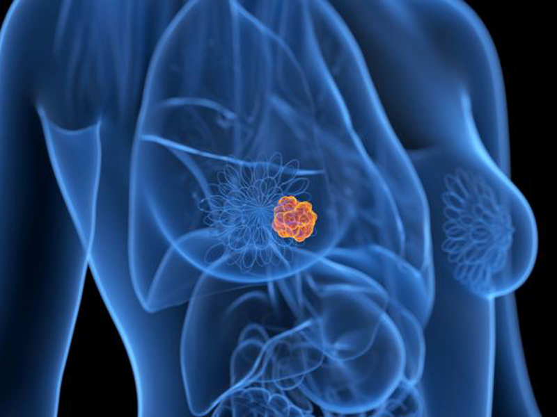 Cuál es el síntoma poco habitual que puede indicar cáncer de colon
