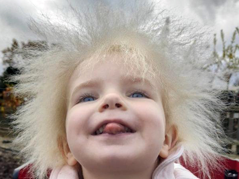 ‘El pelo de mi hija es hermoso’: qué es el síndrome del cabello impeinable causado por una mutación genética