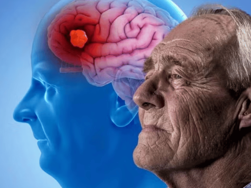 La hipertensión no tratada en adultos puede aumentar el riesgo de Alzheimer