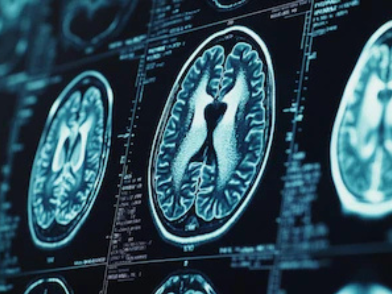 Avance en neurotecnología: implante cerebral convierte pensamientos en palabras y se activa con contraseña